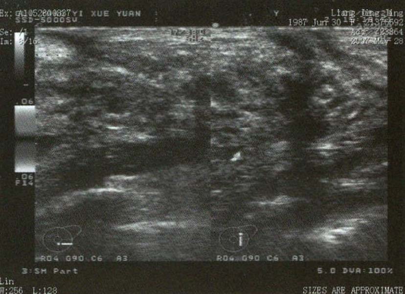 乳腺結(jié)核